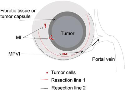 Revisiting Surgical Strategies for Hepatocellular Carcinoma With Microvascular Invasion